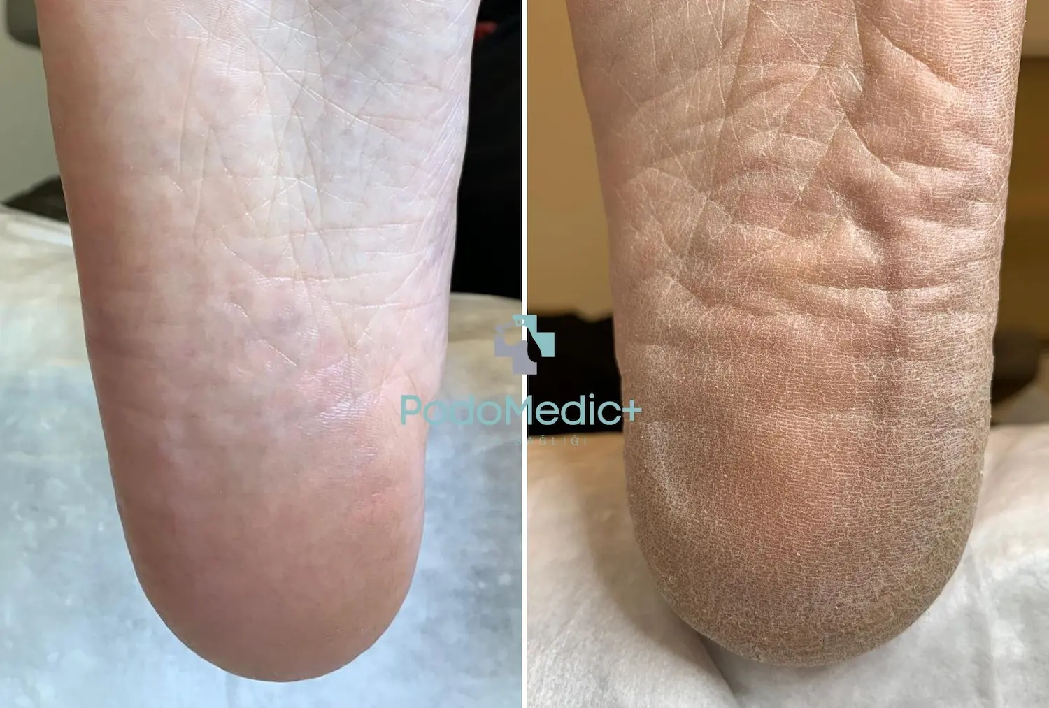 Çatlak Topuk Tedavisi